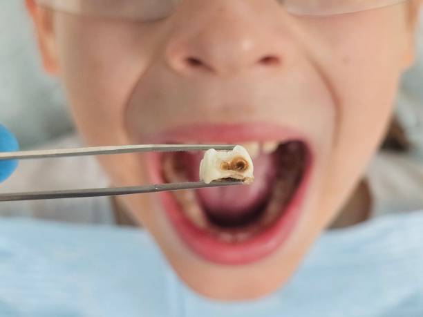 Best Emergency Tooth Extraction  in Stonewall, LA